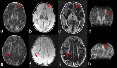 Case Report: Compound Heterozygous Variants in MOCS3 Identified in a Chinese Infant With Molybdenum Cofactor Deficiency